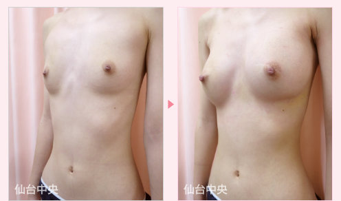 綺麗な美乳作製 症例写真3