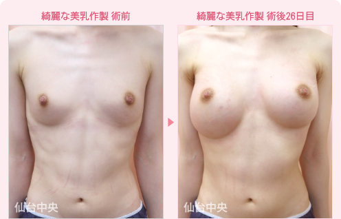 綺麗な美乳作製 症例写真1