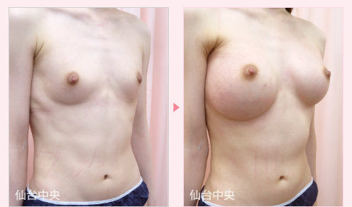 綺麗な美乳作製 症例写真2