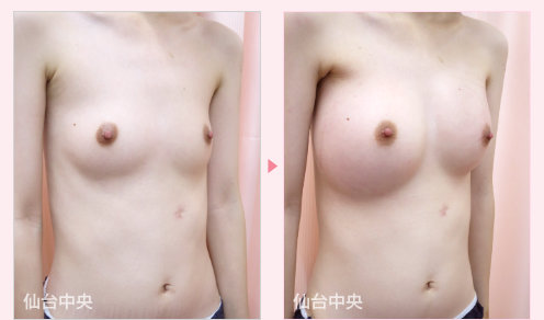 綺麗な美乳作製 症例写真2