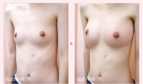 綺麗な美乳作製 症例写真3