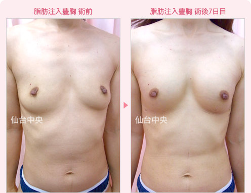 脂肪注入豊胸 症例写真1
