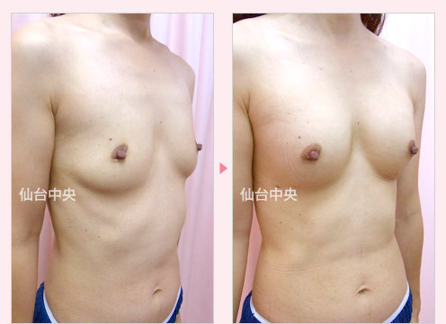 脂肪注入豊胸 症例写真2
