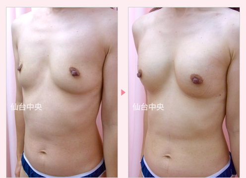 脂肪注入豊胸 症例写真3