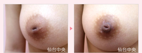 陥没乳頭修正 症例写真