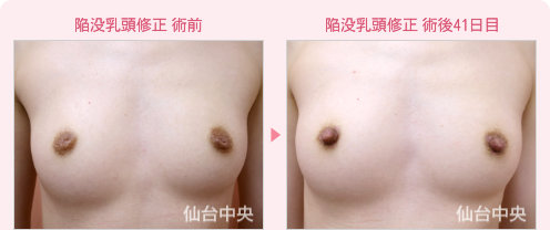 陥没乳頭修正 症例写真