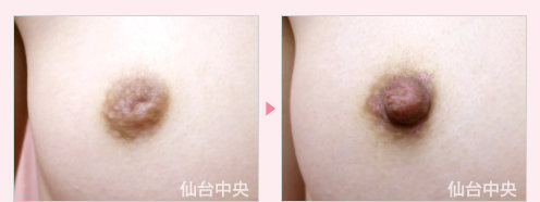陥没乳頭修正 症例写真