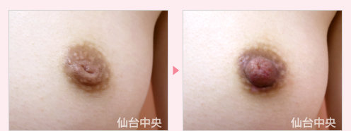陥没乳頭修正 症例写真