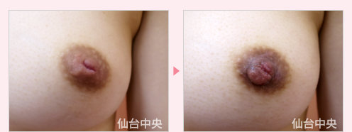 陥没乳頭修正 症例写真
