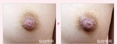 陥没乳頭修正 症例写真