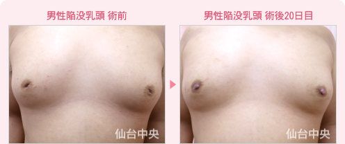 男性陥没乳頭 症例写真1