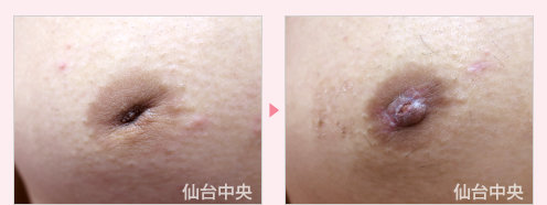 男性陥没乳頭 症例写真2