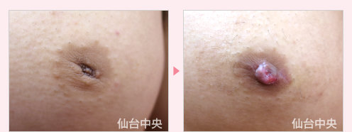 男性陥没乳頭 症例写真3