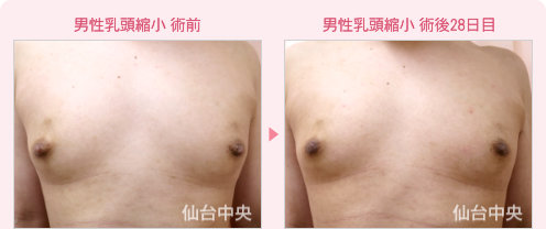 男性乳頭縮小 症例写真1
