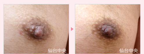 男性乳頭縮小 症例写真3