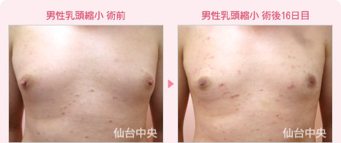 男性乳頭縮小 症例写真1