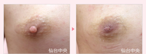 男性乳頭縮小 症例写真2