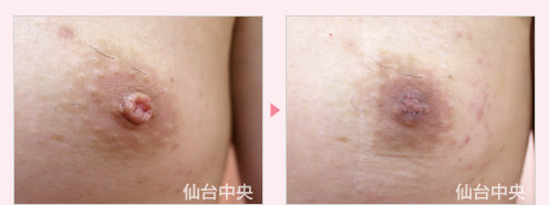 男性乳頭縮小 症例写真3
