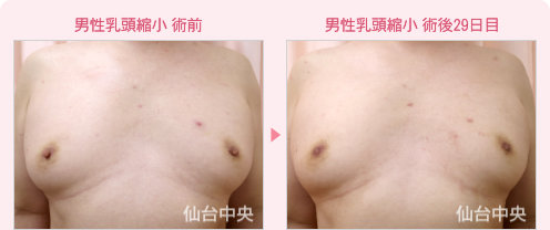 男性乳頭縮小 症例写真1