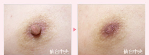 男性乳頭縮小 症例写真2