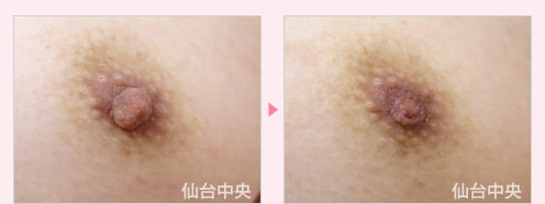 男性乳頭縮小 症例写真3