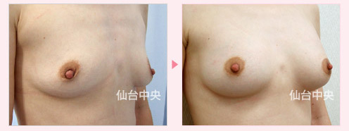 豊胸美乳手術 症例写真2