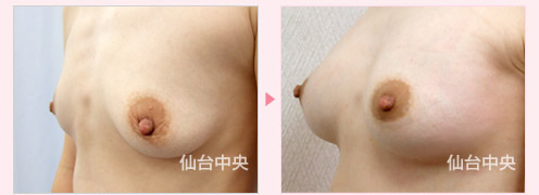 豊胸美乳手術 症例写真3