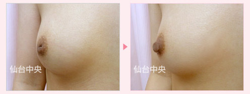 陥没乳頭修正手術 症例写真2