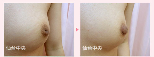陥没乳頭修正手術 症例写真3
