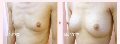 豊胸美乳手術 症例写真3