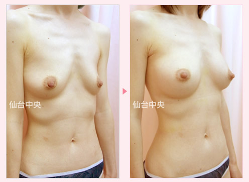 出産授乳後の豊胸手術 症例写真2