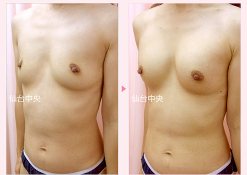 脂肪注入による豊胸手術 症例写真3