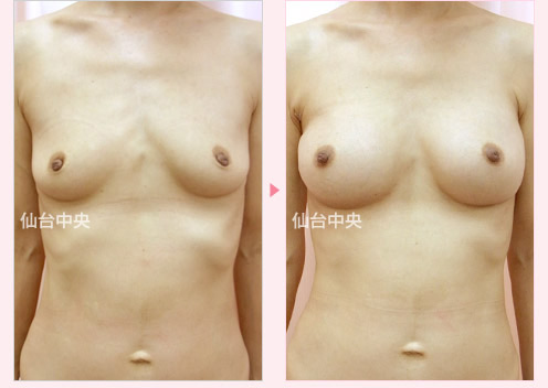 出産授乳後の豊胸手術 症例写真1