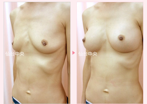 出産授乳後の豊胸手術 症例写真3