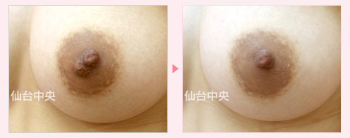 変形乳頭修正 症例写真2