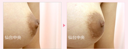 変形乳頭修正 症例写真3