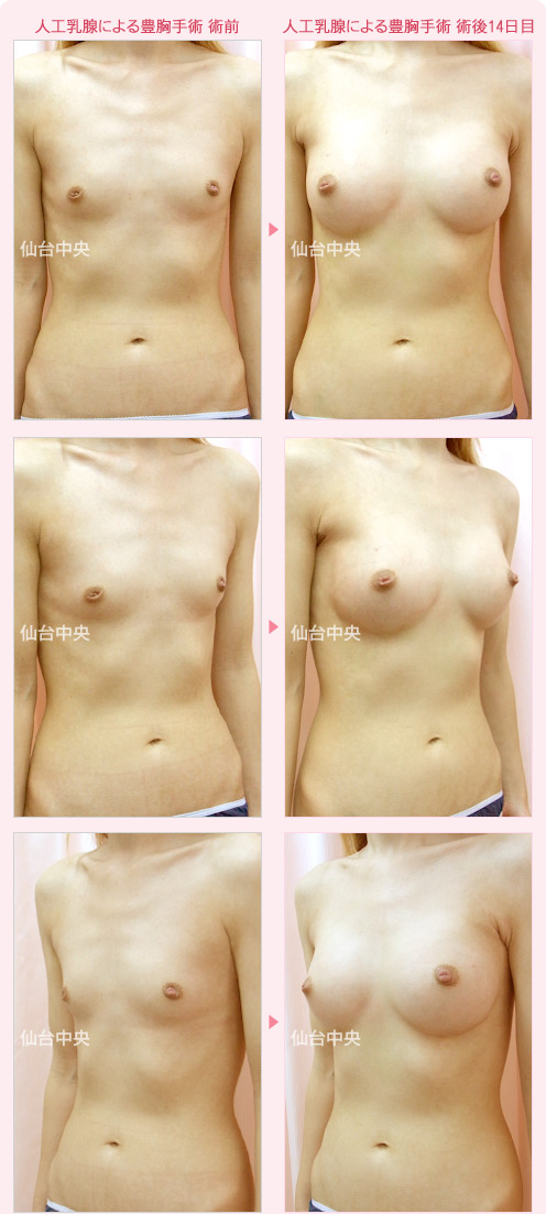 人工乳腺による豊胸手術