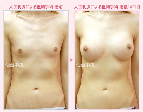 人工乳腺による豊胸手術 症例写真1