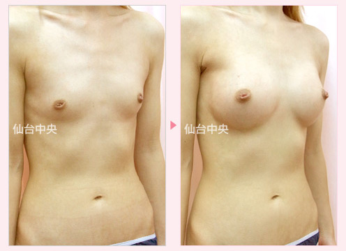 人工乳腺による豊胸手術 症例写真2