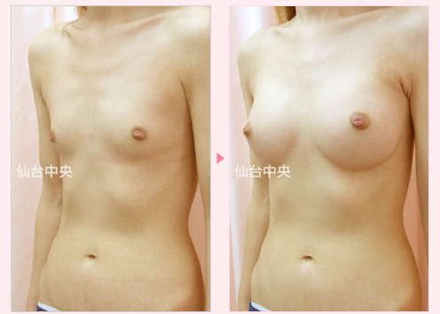人工乳腺による豊胸手術 症例写真3