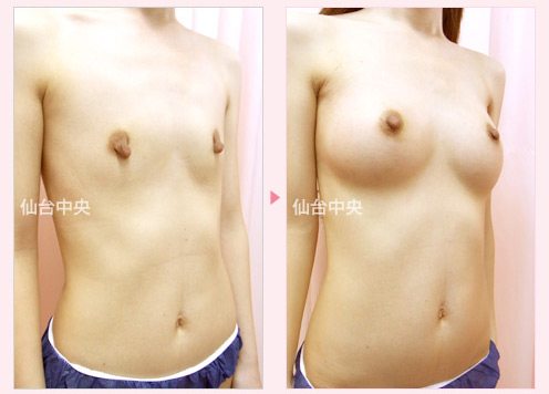 豊胸と乳頭縮小同時手術 症例写真2