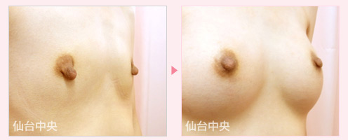 豊胸と乳頭縮小同時手術 症例写真5