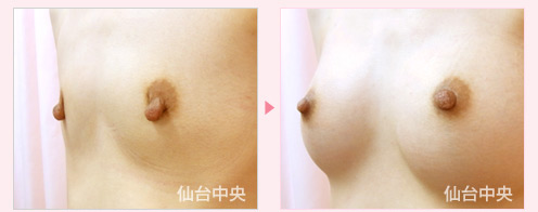 豊胸と乳頭縮小同時手術 症例写真6