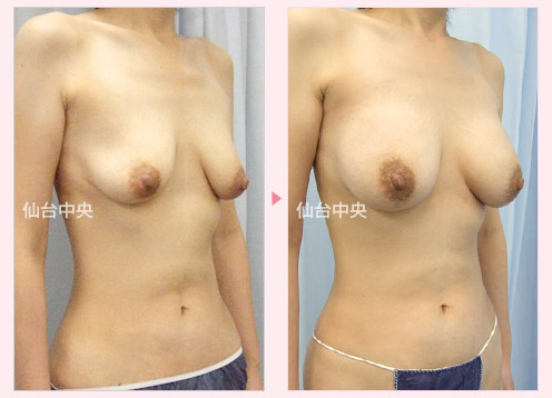 下垂した胸の豊胸手術 症例写真2