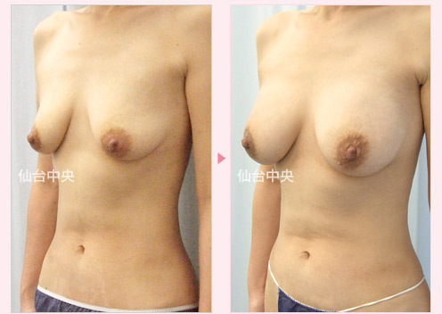 下垂した胸の豊胸手術 症例写真3