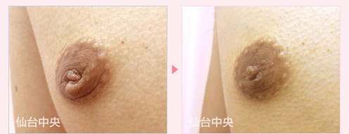 男性乳頭整形手術 症例写真3