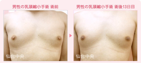 男性の乳頭縮小手術 症例写真1