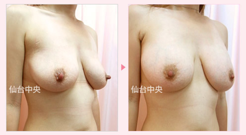 豊胸と乳頭縮小同時手術 症例写真2