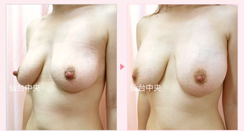 豊胸と乳頭縮小同時手術 症例写真3