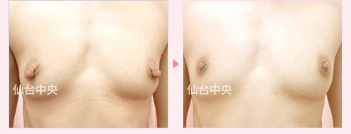 乳頭縮小 症例写真1